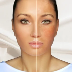 Melasma treatment at a skin clinic in Kolkata