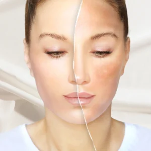 Skin whitening treatment at a clinic in Kolkata